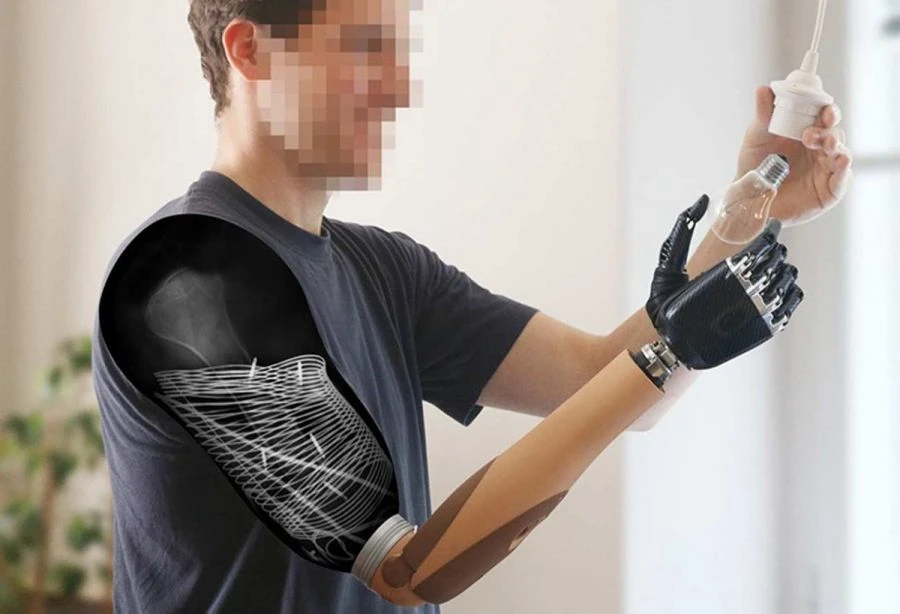 Electromechanical Shoulder Prosthesis with Contact Control System
