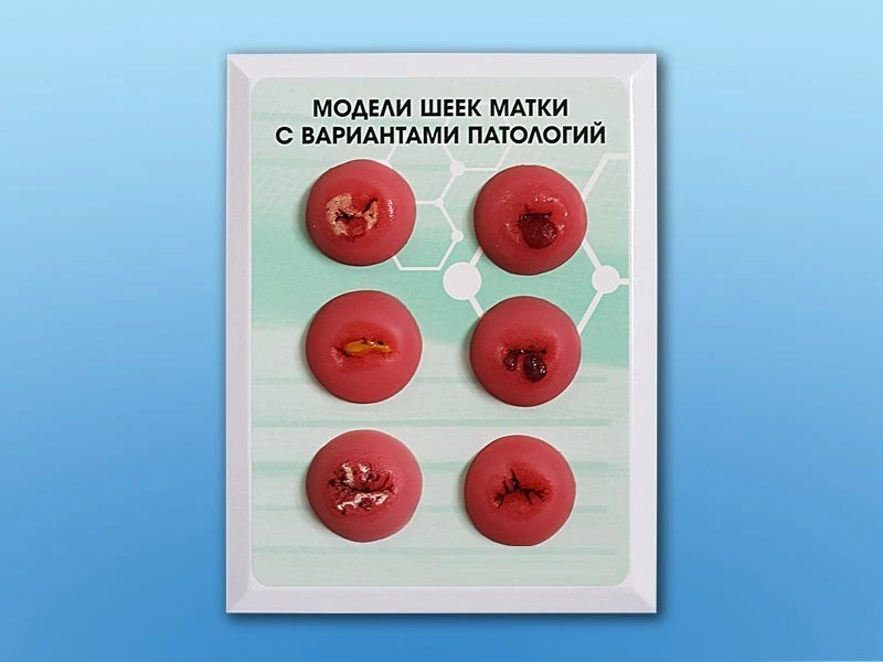 نموذج تعليمي لعيوب عنق الرحم GP6611