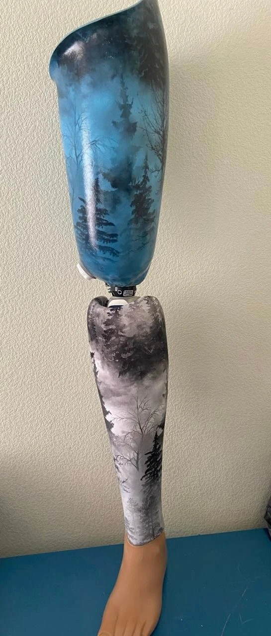 Modular Hip Prosthesis for Congenital Deformities