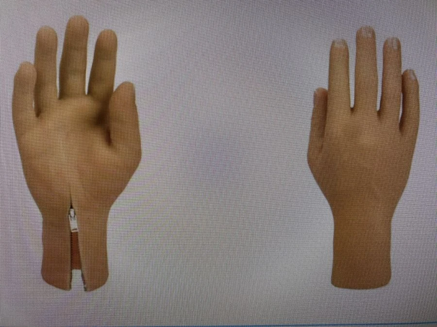 Cosmetic Hand Prosthesis for Partial Hand Amputation