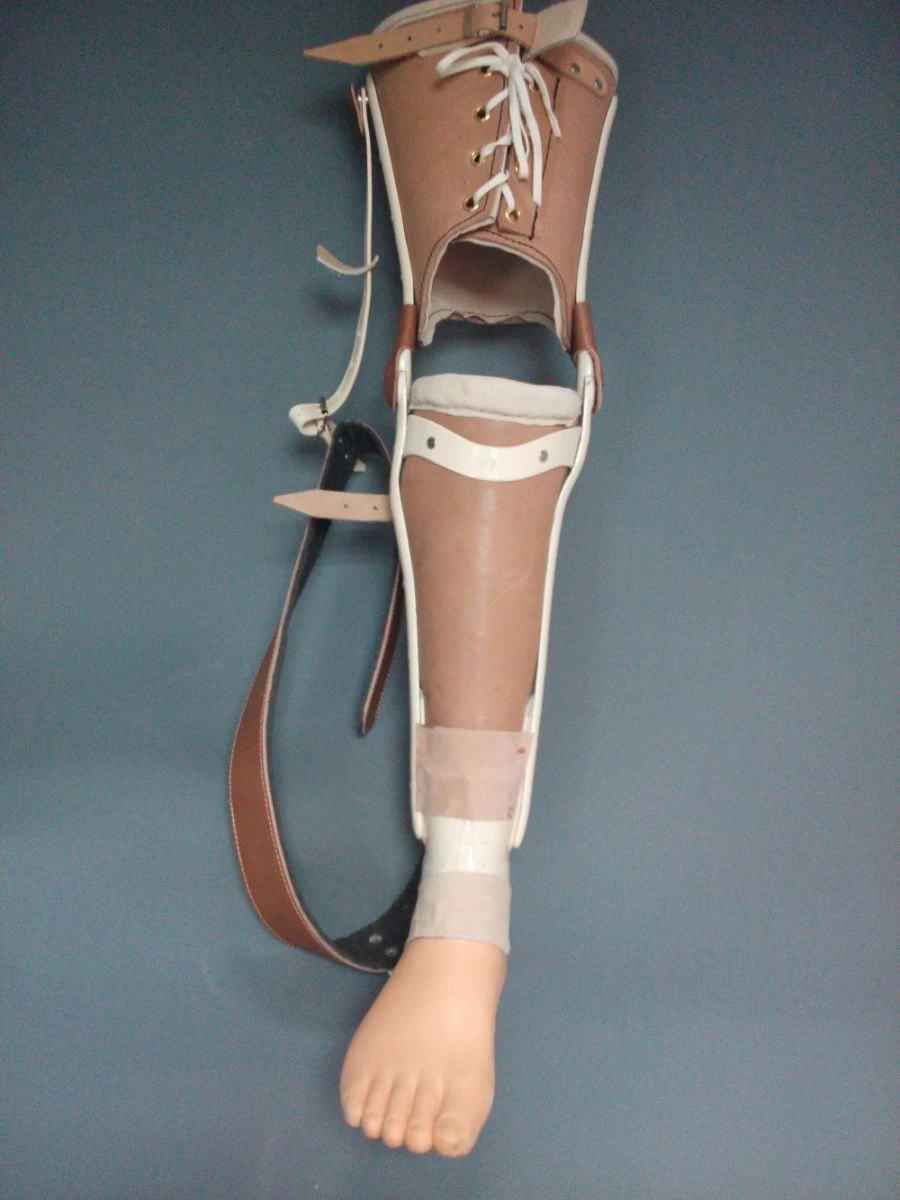 Non-modular Shin Prosthesis for Congenital Deficiencies