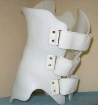 Functional Correction Corset for Scoliosis Treatment