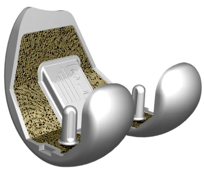 مكونات الفخذ اليسارية لاستبدال الركبة (الأحجام 1-5)